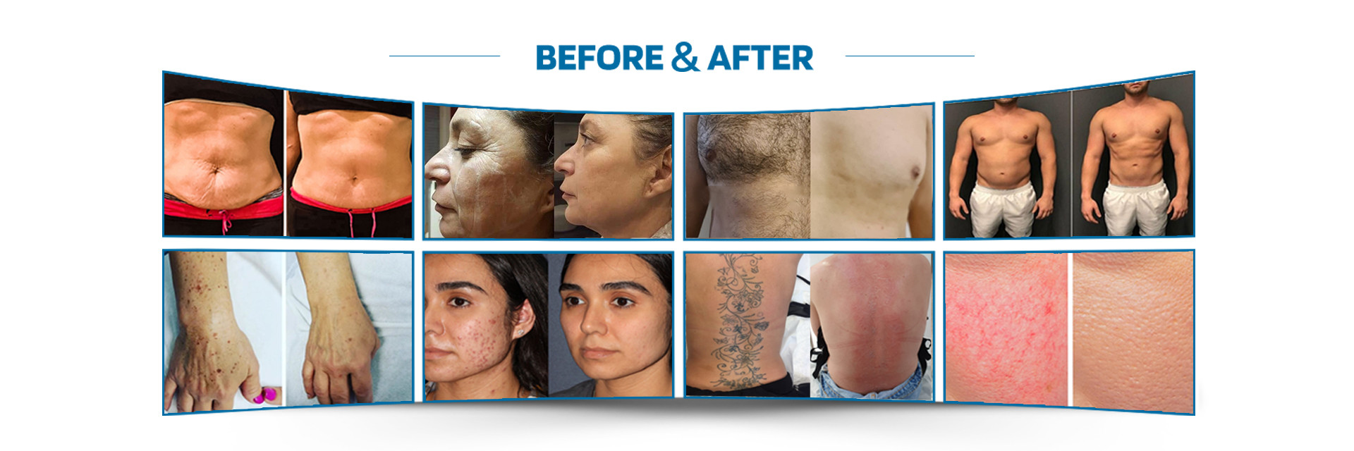 kualitas mesin penghilang bulu laser pabrik