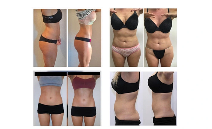 Lipolaser lipolisis 6D canggih 209mw Super 6d Lipo Laser Liposuction Machine dengan 635nm 650nm 780nm 810nm 940nm 980nm 6