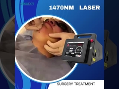 Endolaser 1470 Lifting Lipolisis Wajah Endovenous Laser Spider Vein Penghapusan